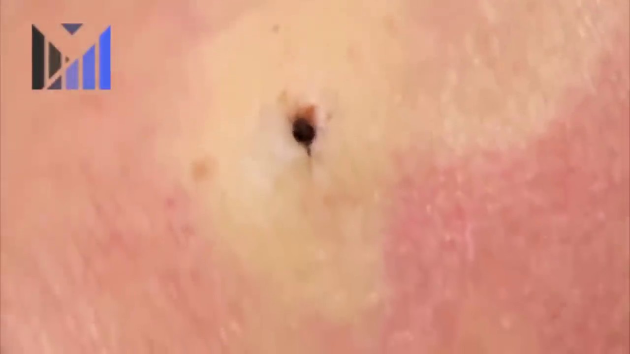 MOST SATISFYING PIMPLE POPPING APRIL 2019