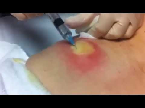 Most SATISFYING Pimple Popping Moments 2021 – Part 14