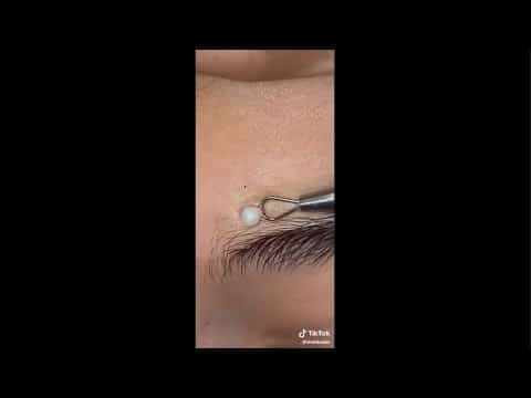 Most Satisfying Pimple Popping Moments 2020 – Part 8