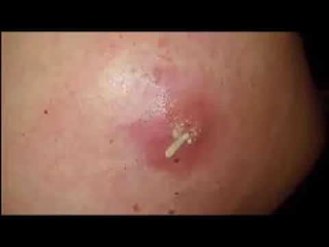 Most satisfying Pimple Popping moments 2020 – Part 7