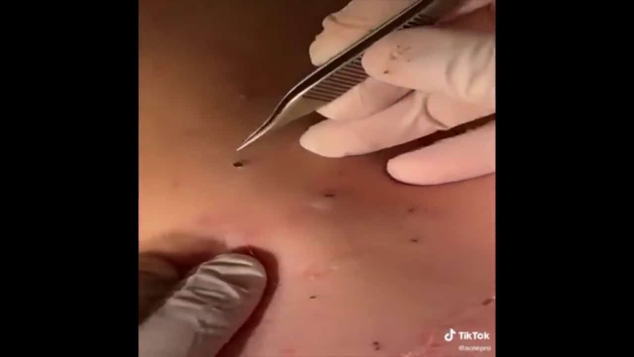 Most Satisfying Pimple Popping Moments 2020 – Part 6