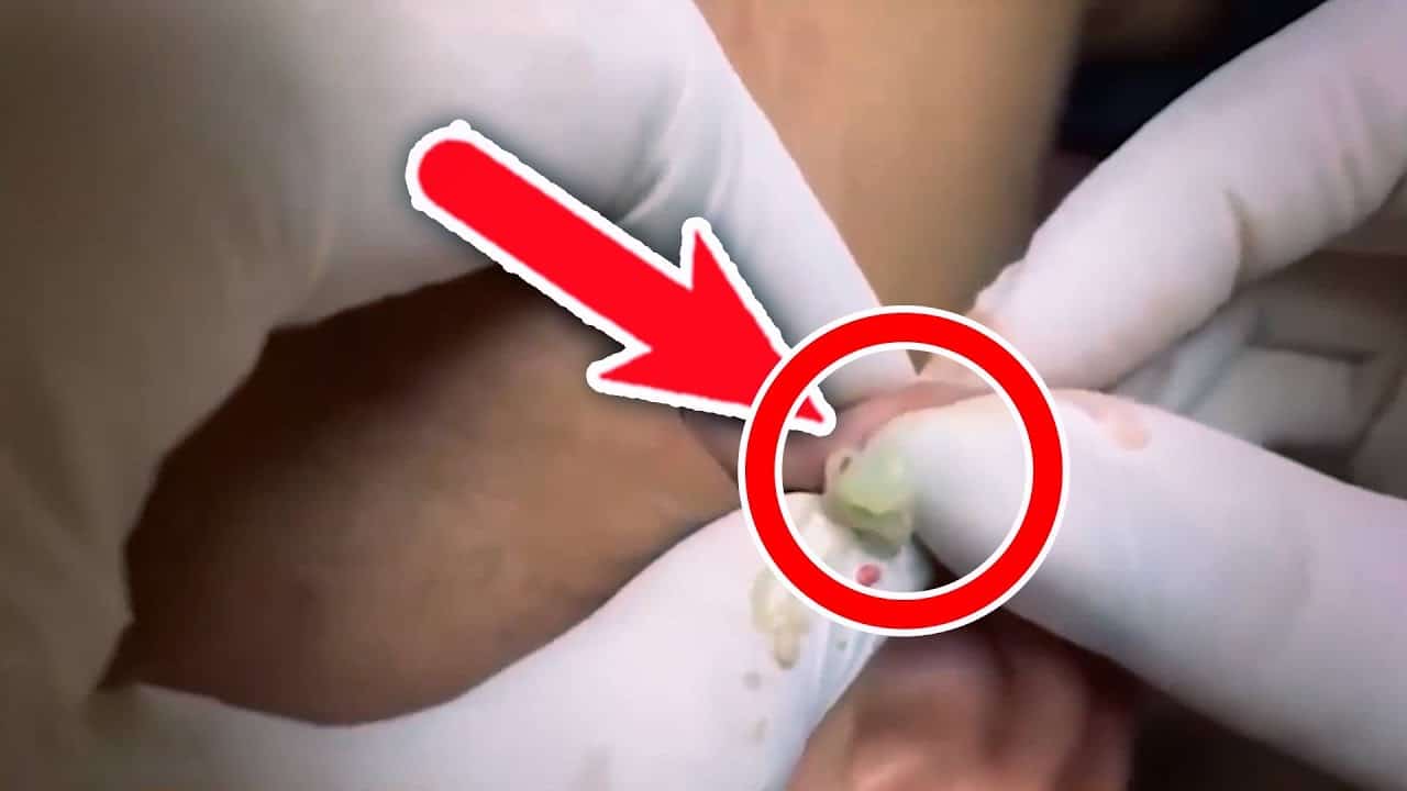 Most satisfying Pimple Popping moments 2020 – Part 4