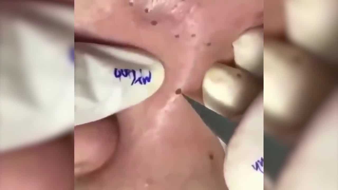 Most satisfying Pimple Popping moments 2021 – Part 7
