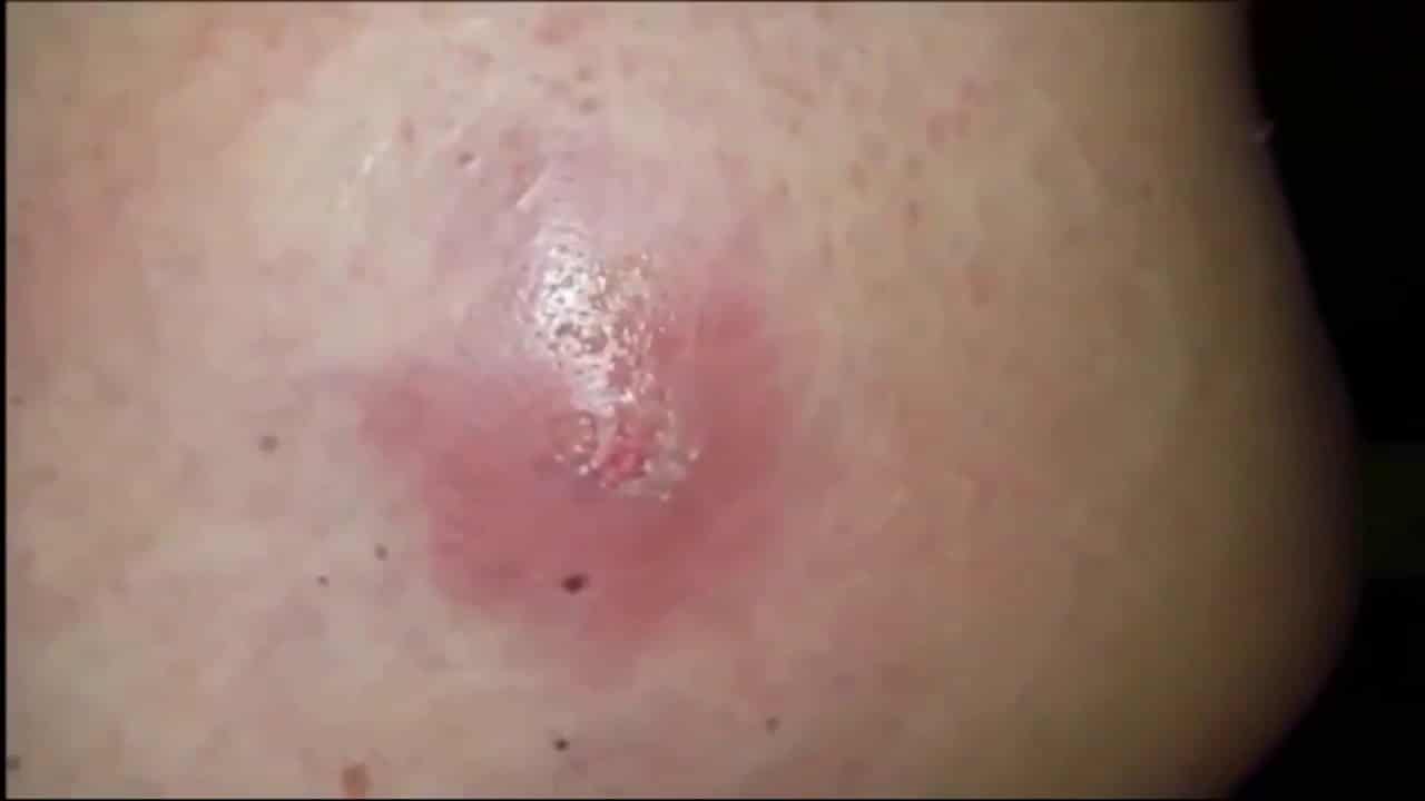 Most satisfying Pimple Popping moments 2021 – Part 6