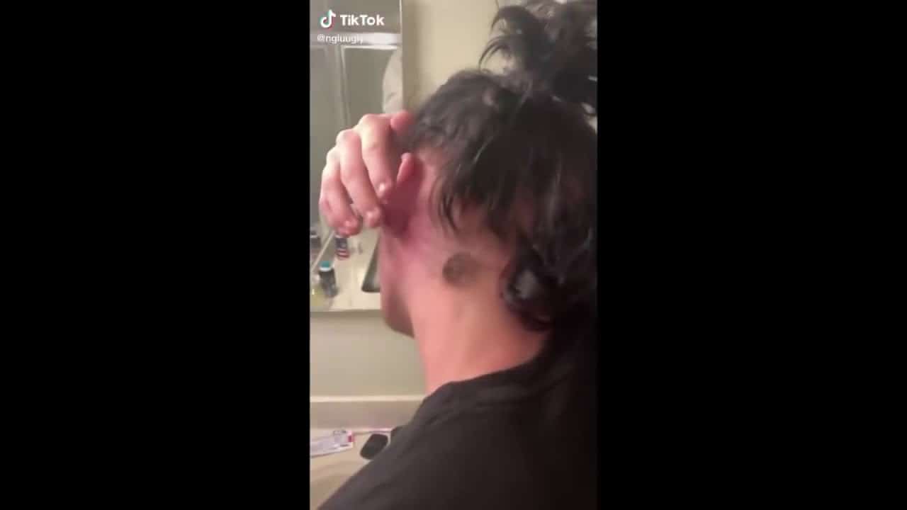 Most satisfying Pimple Popping moments 2021 – Part 5