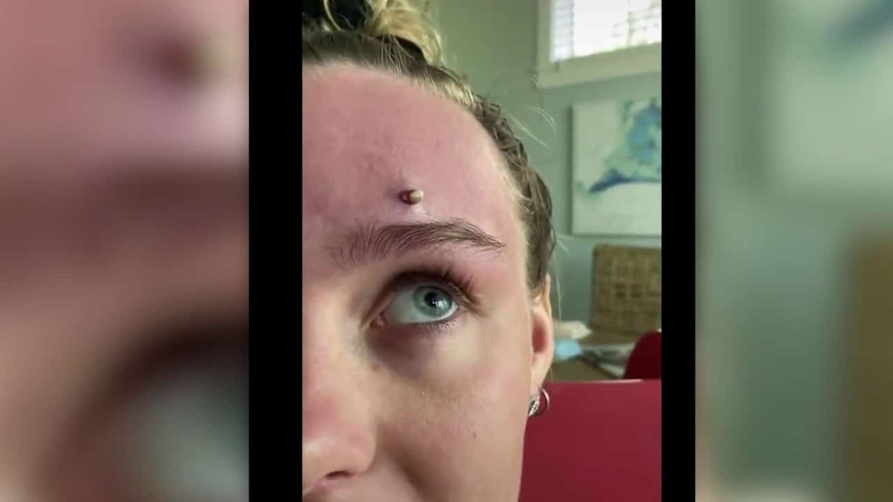 Most satisfying Pimple Popping moments 2020 – Part 10