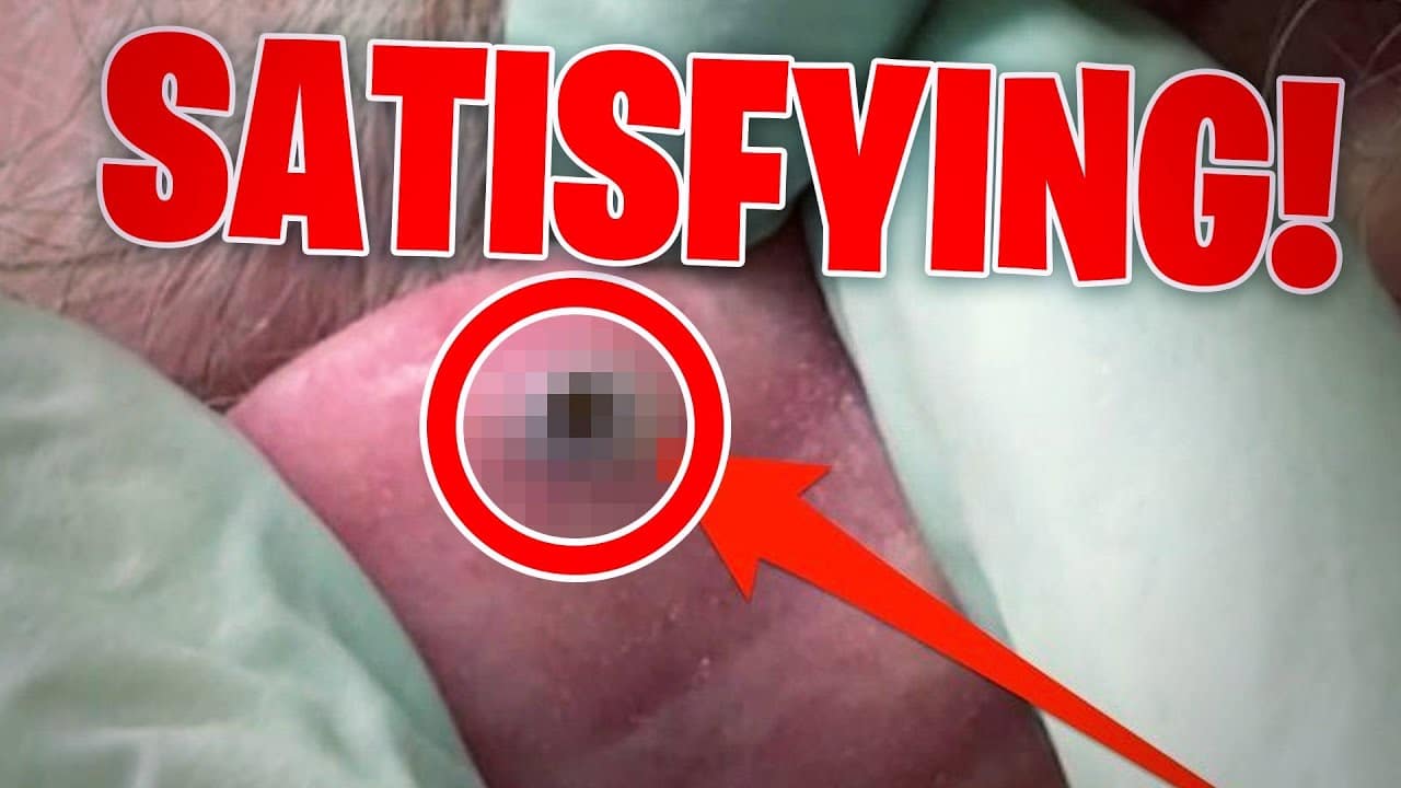 Most SATISFYING Pimple Popping moments 2021 – Part 15