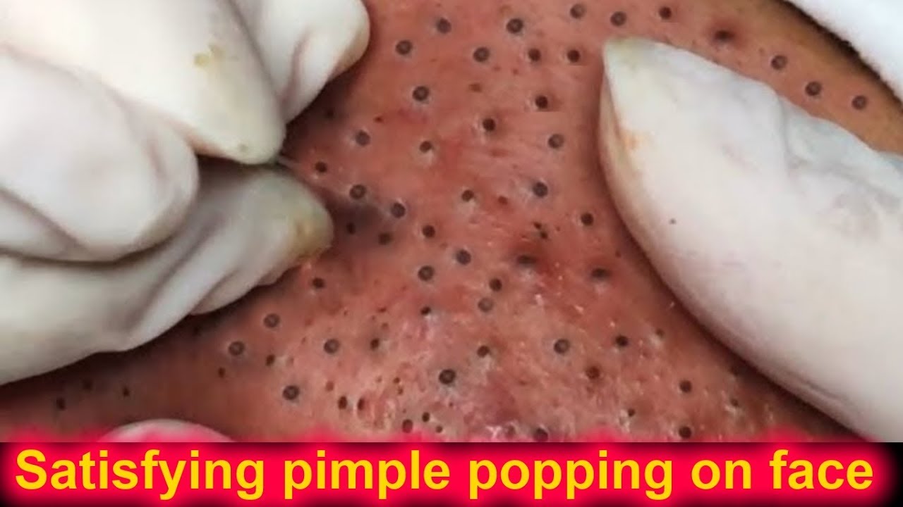 Most Satisfying pimple popping on face Cleaning the blackheads whiteheads