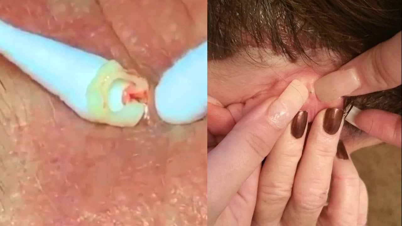 Most Satisfying Pimple Popping!  Whiteheads, Comedones and Zits