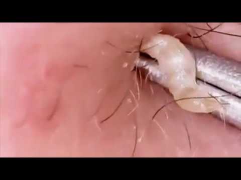 Most Satisfying Pimple Popping!!