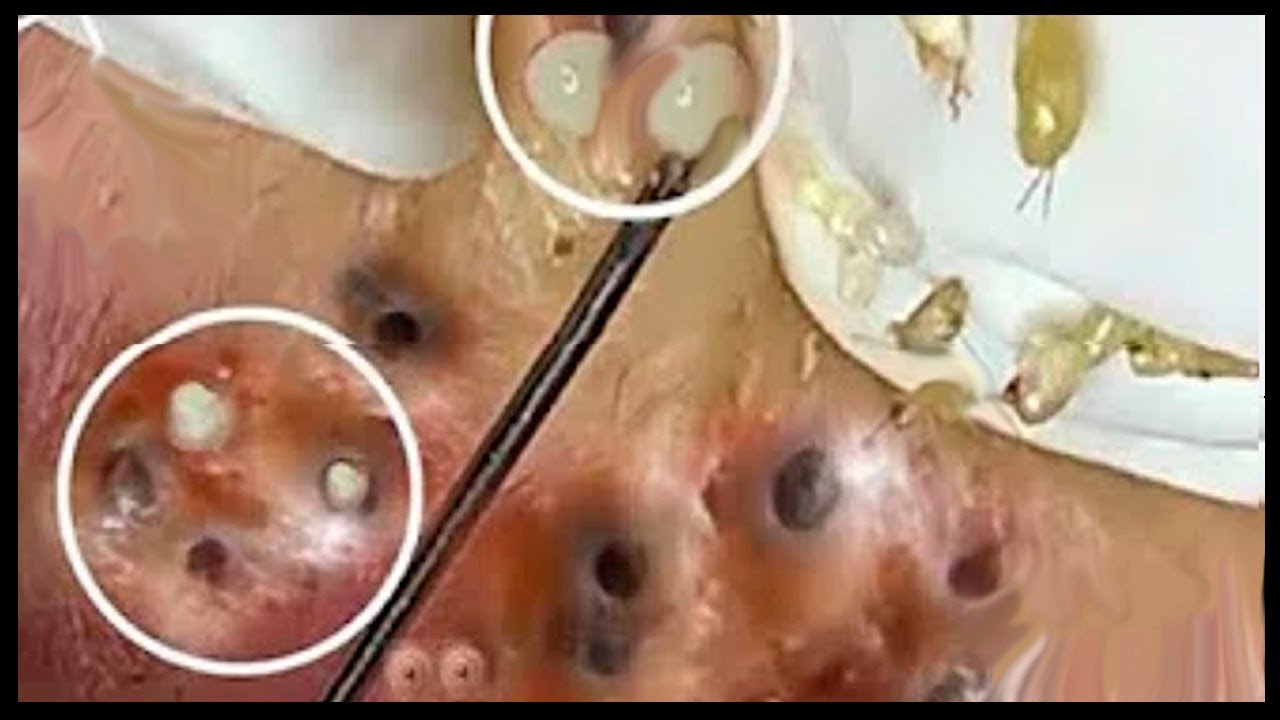Most Satisfying Pimples and Blackheads Removal Videos # 36 # blackheads removal # pimples removal