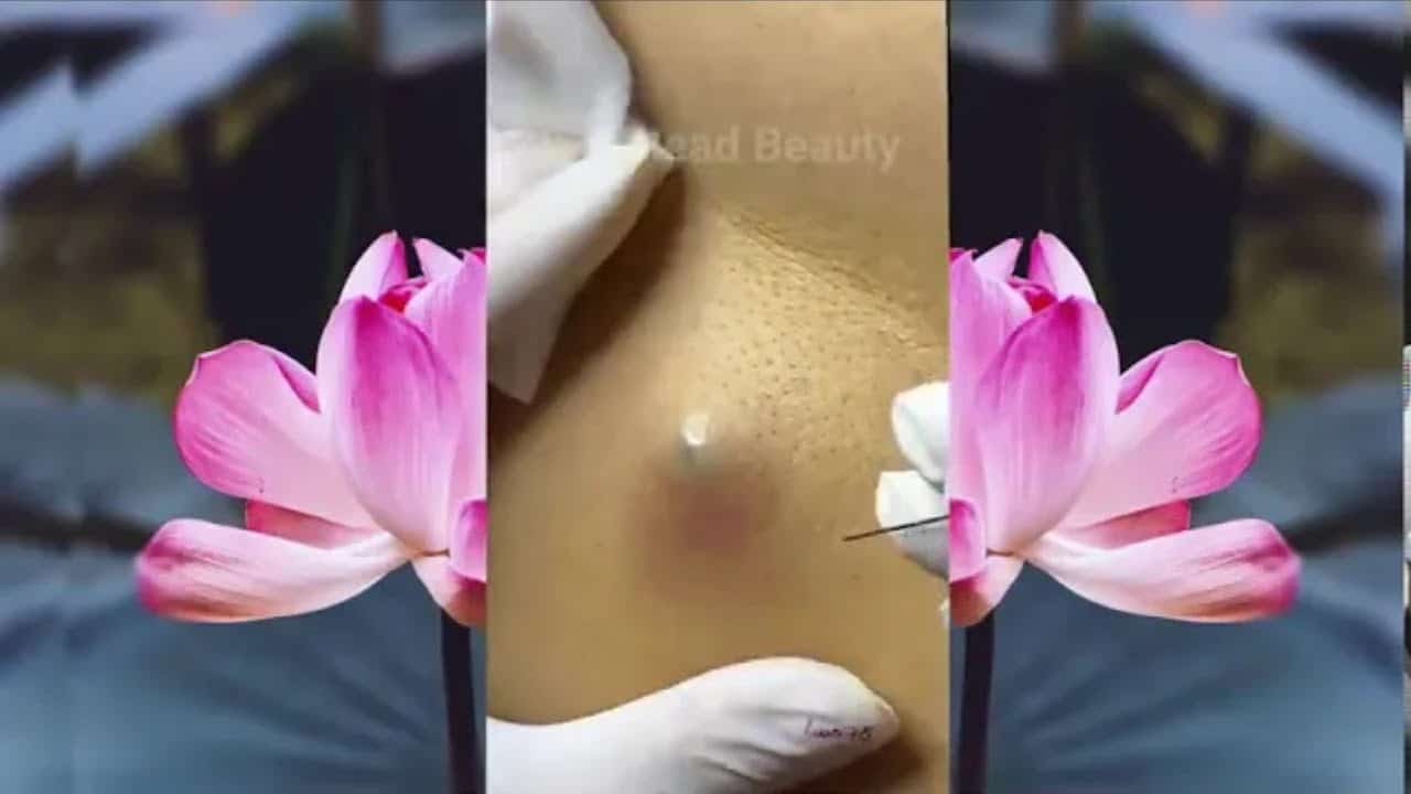Most Satisfying Removal Of Blackheads ?? | Must Watch