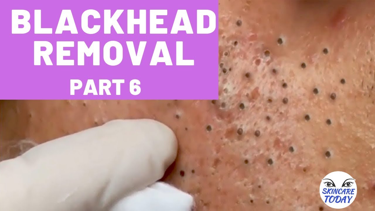 Most Satisfying Video Face Skin Care (blackhead removal) with Relaxing Sleep Music | Part 6