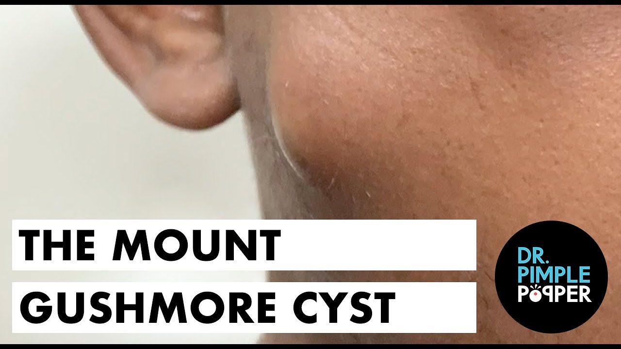 Mount Gushmore the Cheek Cyst