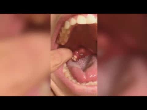 Mouth Pimple popping, Pimple & Cyst popping this week, blackheads, acne popping & relaxing music