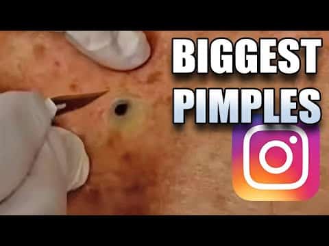 Mr. Blackhead's Best Pimple Pops of Instagram!  Pimple Popping Spectacular
