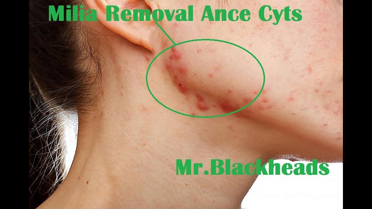 Mr Blackheads | Milia removal ance cytsic on face at home | Phalika skin care