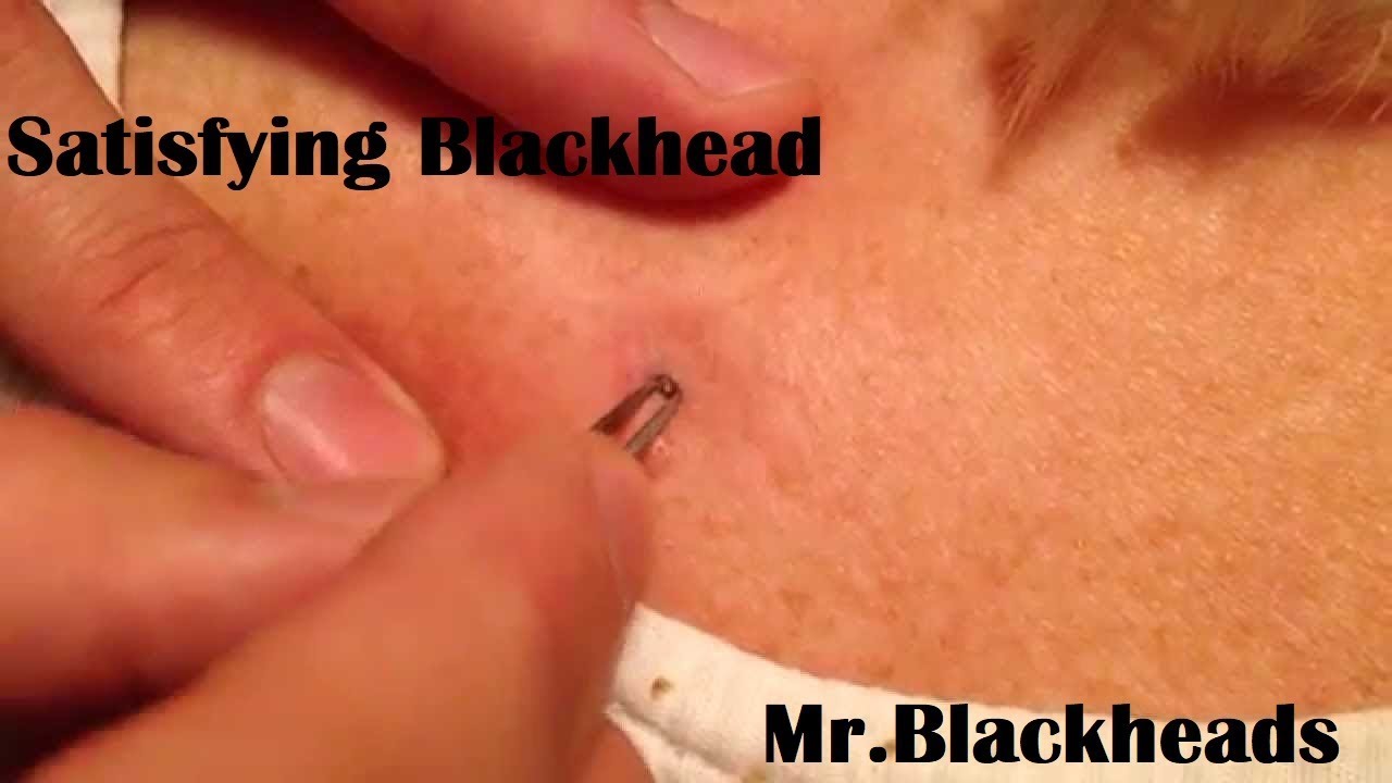 Mr Blackheads | satisfying blackhead remove extraction on face at skin care