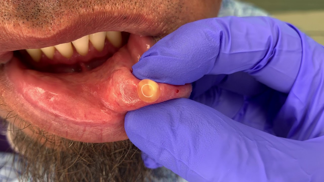 Mucocele (Snot Bubble) Removal on Bottom Lip