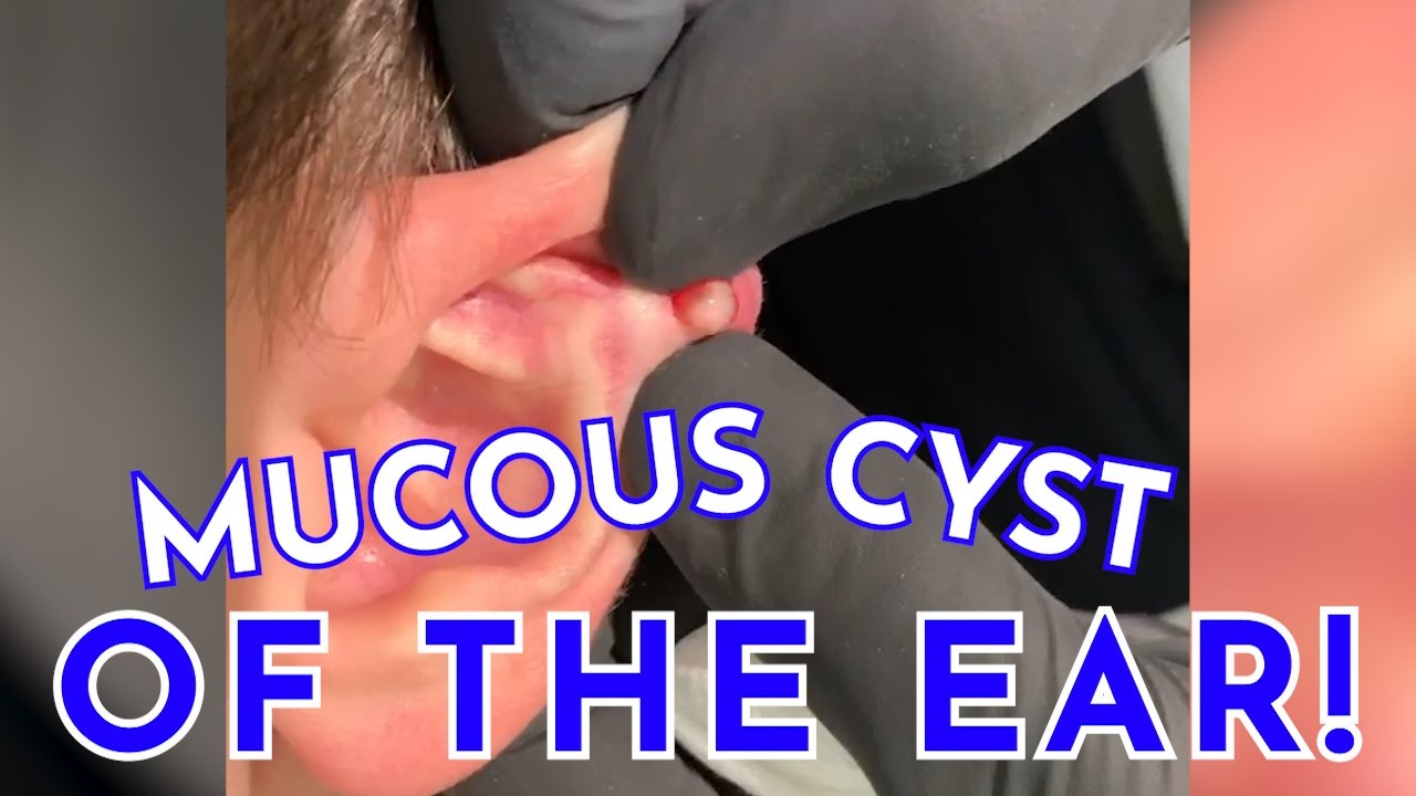 MUCOUS CYST OF THE EAR!