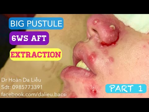 Mụn trứng cá mụn mủ|Dermatologist,pimples,blackhead, hidden acne pustule nodule 6ws aft extraction 1