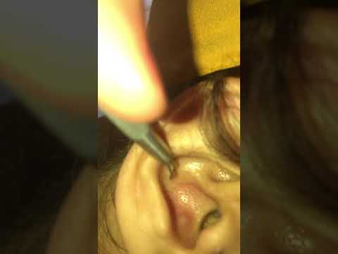 MUST WATCH: SATISFYING PIMPLE POPPING IN EAR ??