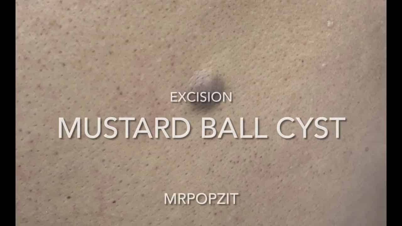 Mustard Ball cyst. Pilar cyst on the back. Yellow mustard pop. Cyst excision and closure. MrPopZit