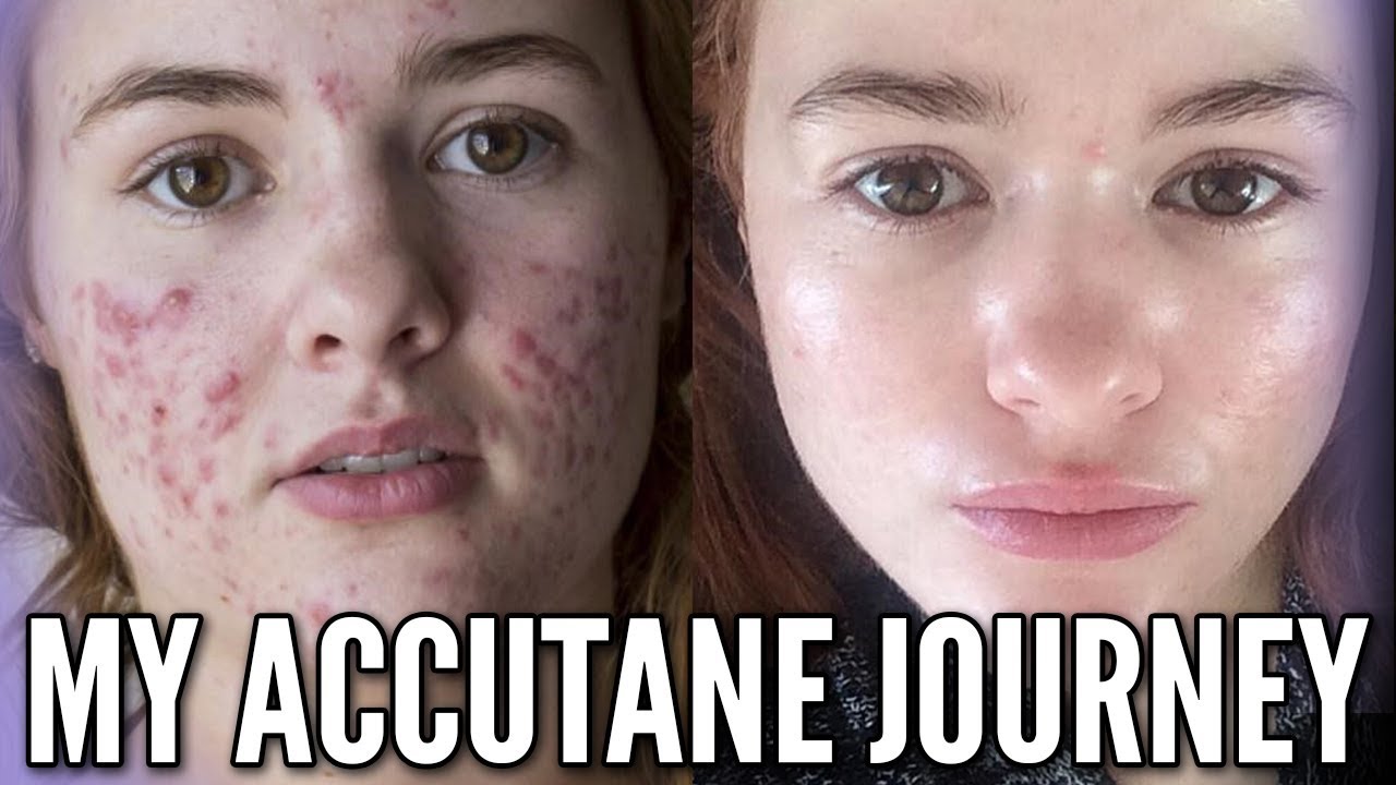 My Accutane Journey with Progress Photos and Relapse Experience!