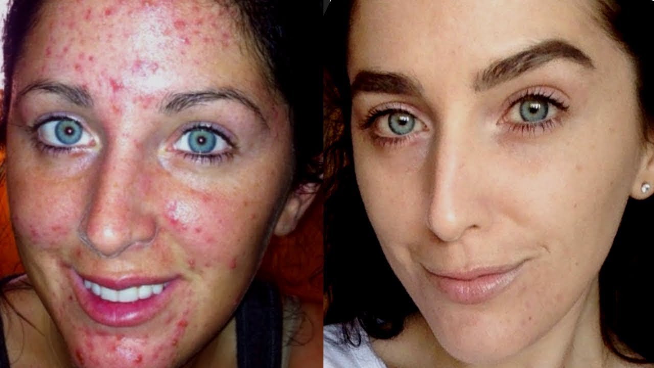My Acne Story and How I Cleared my Skin