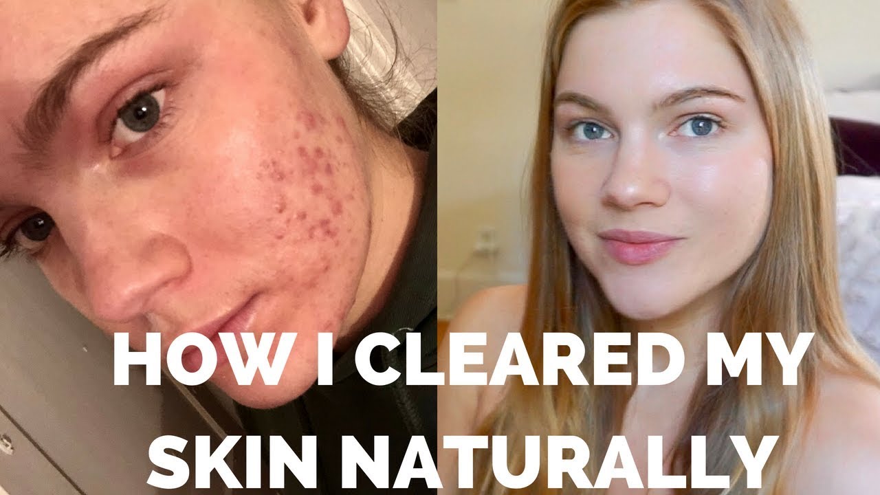 MY ACNE STORY | HORMONAL | CLEARING MY SKIN NATURALLY