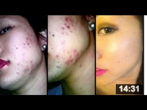 MY ACNE STORY: HOW IT HAS AFFECTED ME EMOTINALLY, SCARRING, ETC