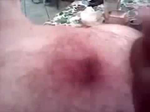 my mom popped a cyst on my back part 1 YouTube