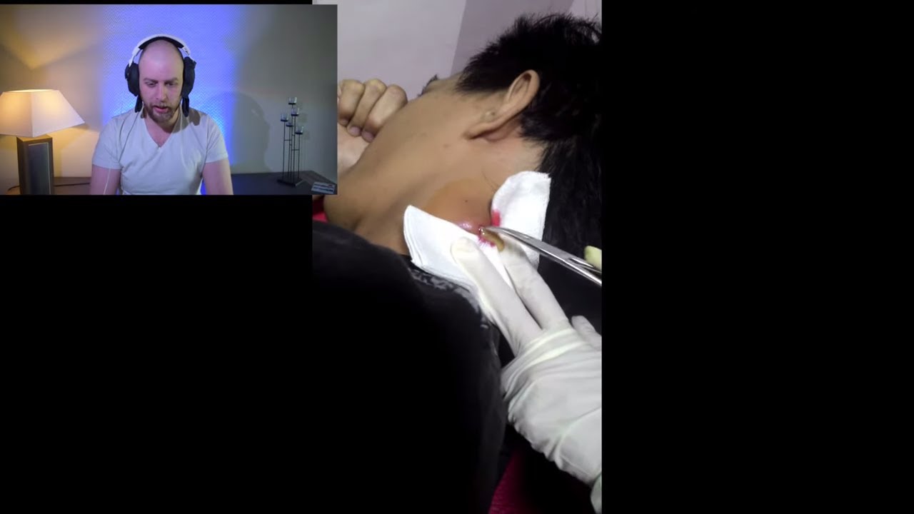 neck cyst full of pus severe infected cyst