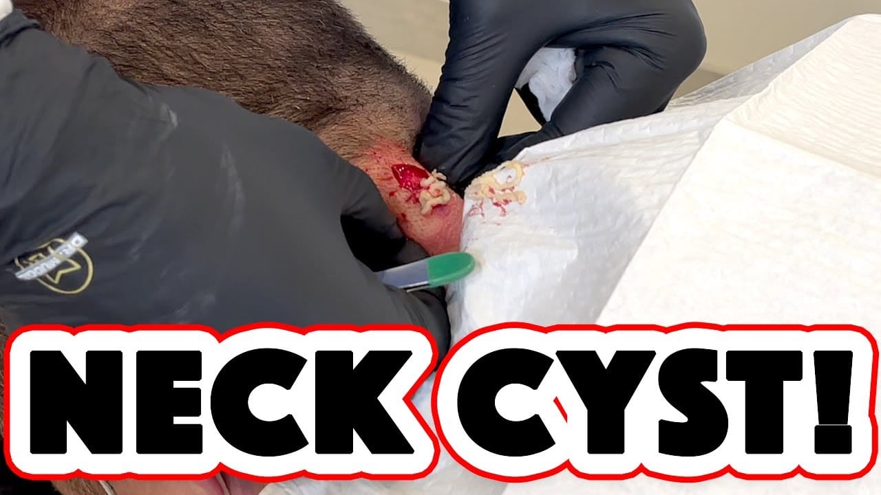 NECK CYST!