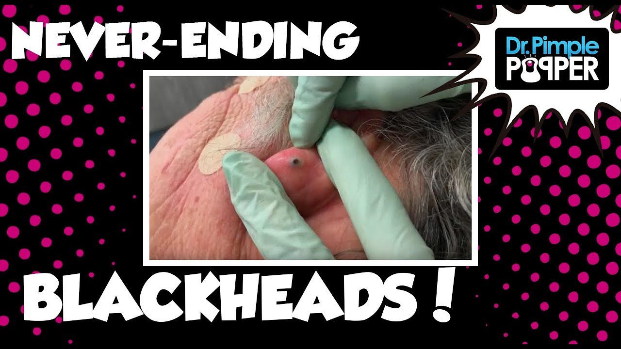 Never Ending Blackhead Surprises!