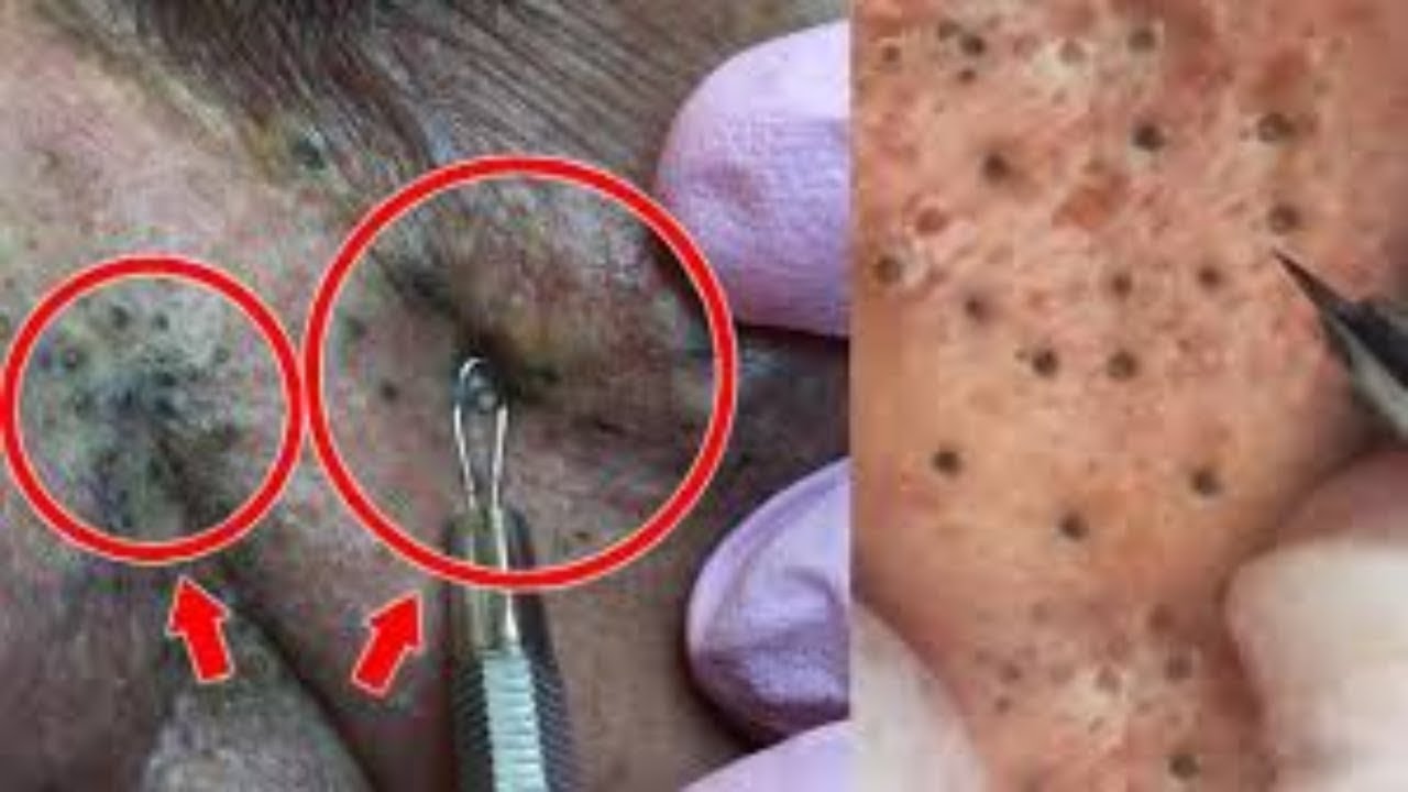 *NEW* 2019 SATISFYING PIMPLE POPPING & BLACKHEAD REMOVAL COMPILATION