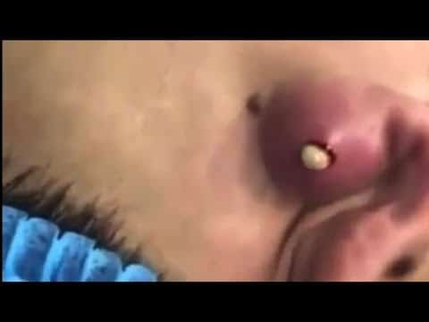 New addictive pimple popping, black head and cyst extraction videos 2021|| Pimple Haven #7
