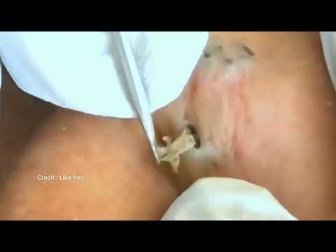 New Biggest Cyst Removal 202