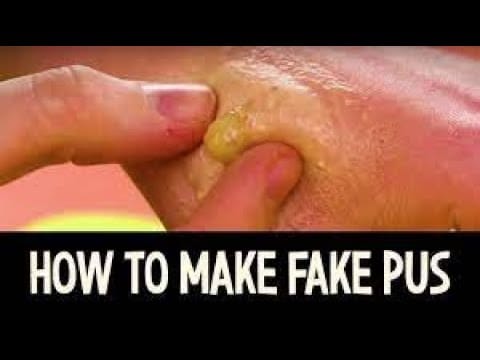 new Blackheads Extraction Whiteheads Removal Pimple Popping