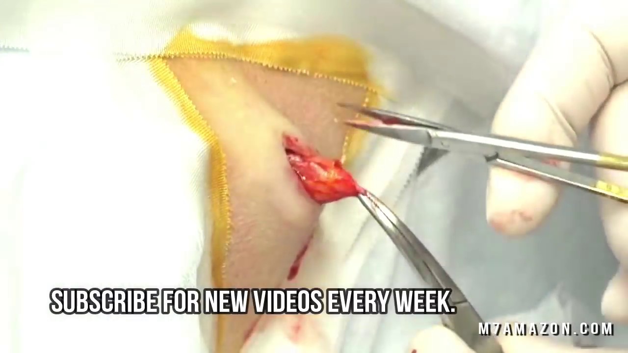 NEW Cyst Popping Preview – Popaholics Rejoice!