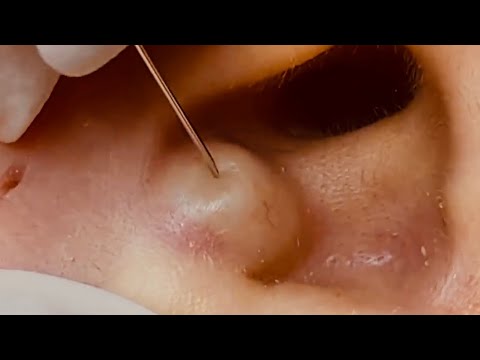 NEW Large Cyst Removal BEST POPS Compilation || w/ relaxing music & an OOZ GALORE!