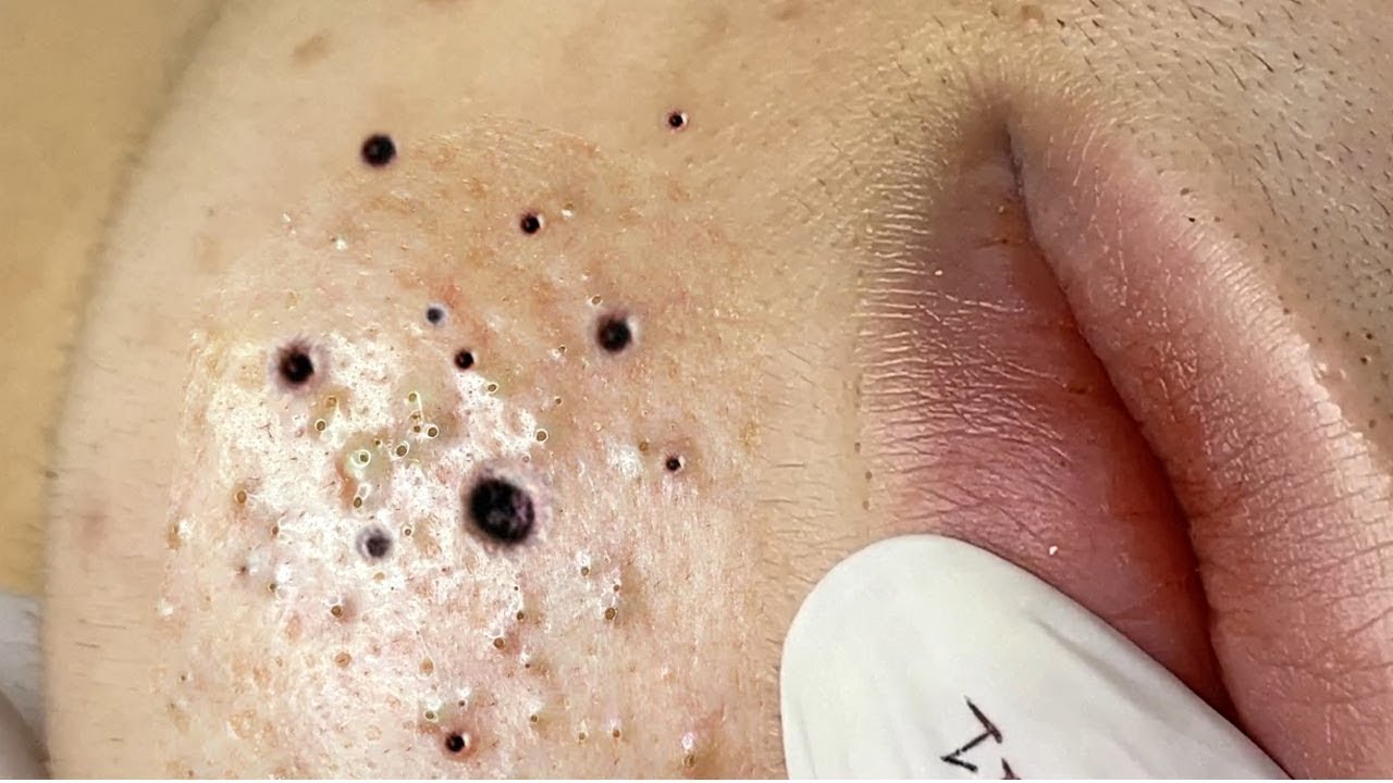New pimple popping videos