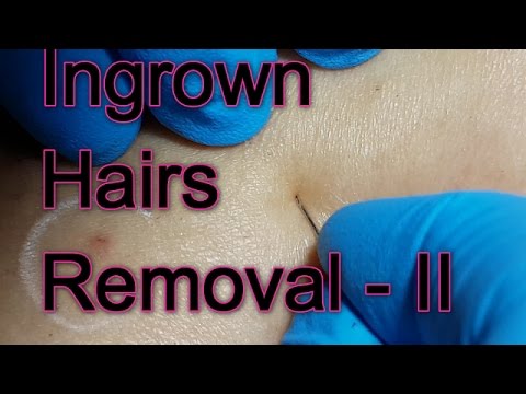 New Session of Ingrown Hairs Removal – II