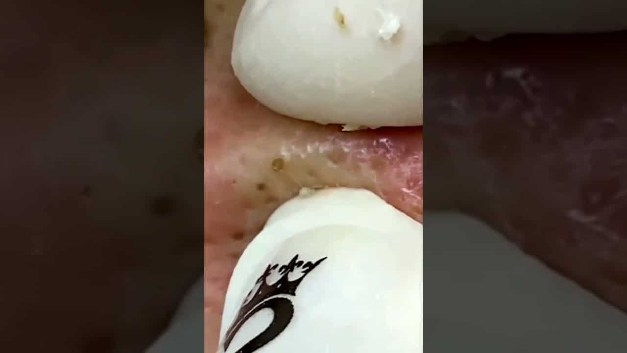Newest pimple popping video 2021 D#75