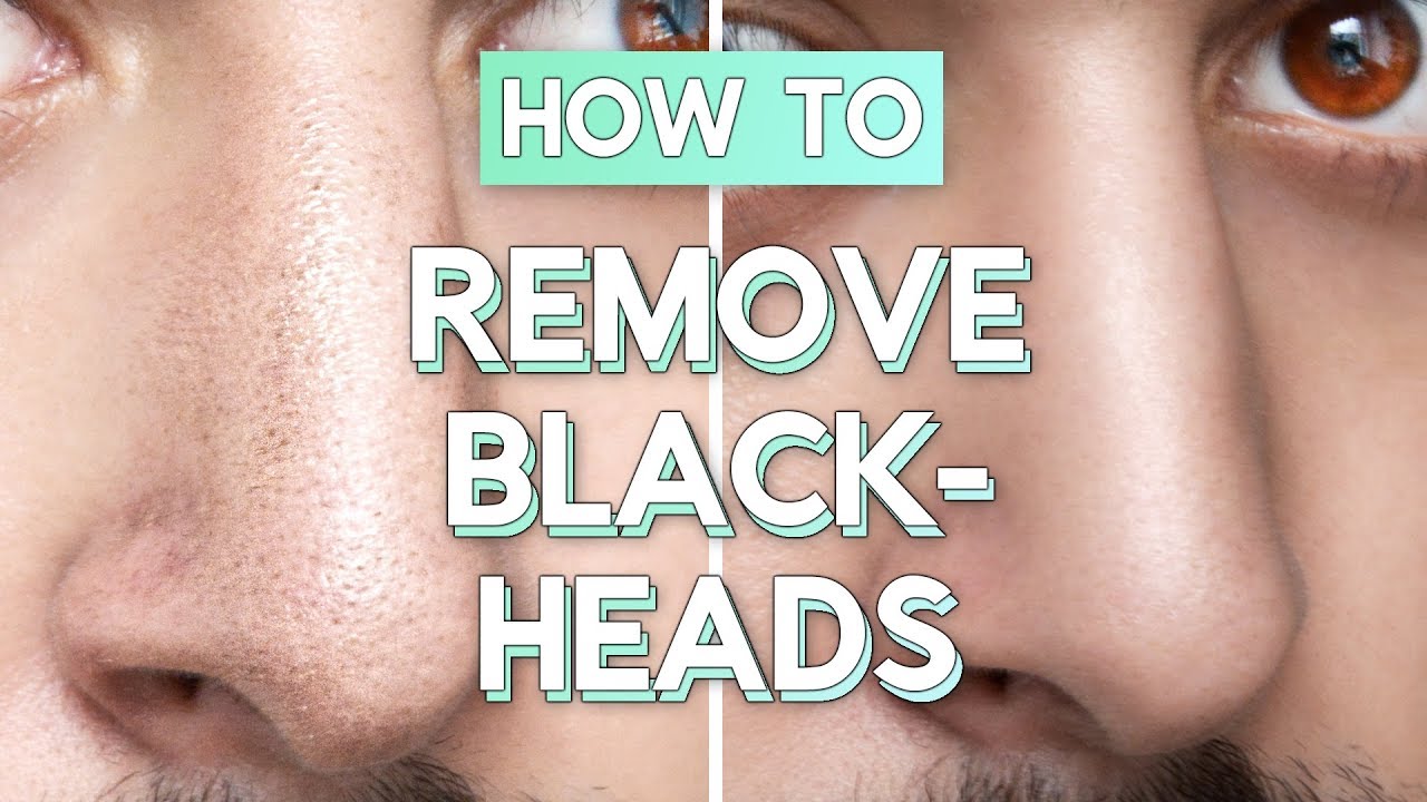 No Bullsh*t Blackhead Removal – How To Remove Blackheads From Face / Nose ✖ James Welsh