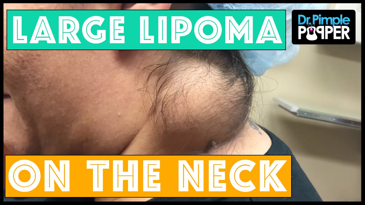 No Eviction Notice Needed: Lipoma on the Neck