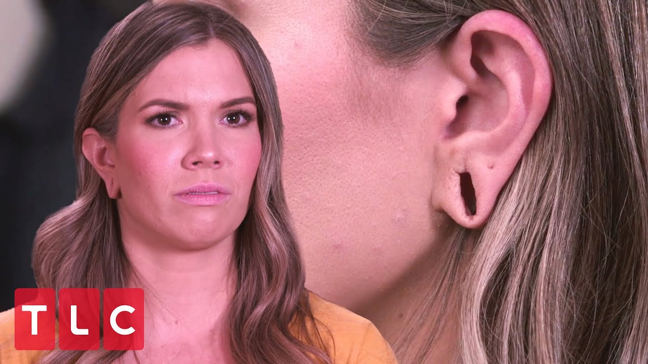 Noelle Wants Her Stretched Ears Fixed | Dr. Pimple Popper