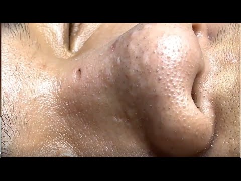 Nose blackhead removal – Pimple popping #2