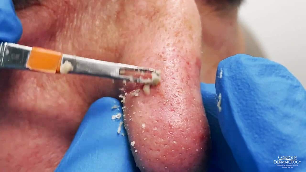 Nose Blackheads Extracted | CONTOUR DERMATOLOGY
