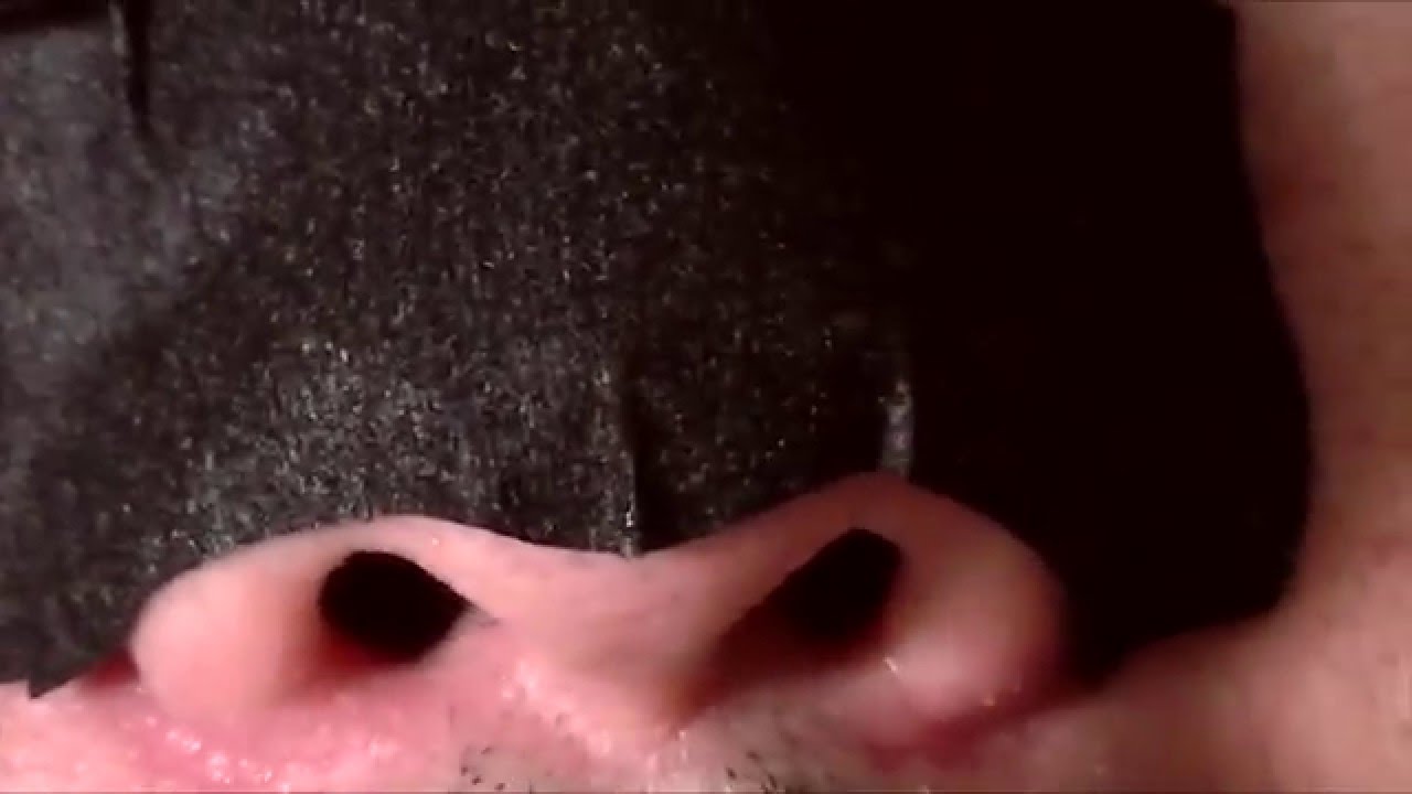 Nose Full Of Blackheads. Blackheads Removal With Pore Strips.